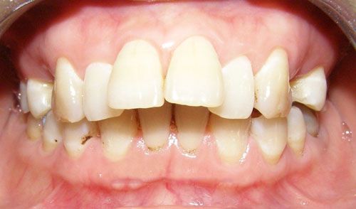 Cách chỉnh 2 răng cửa bị vẩu đều đẹp nhanh và hiệu quả nhất 1