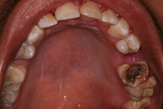 Cách khắc phục răng bị sâu nặng và vỡ lớn HIỆU QUẢ nhất là gì? 1