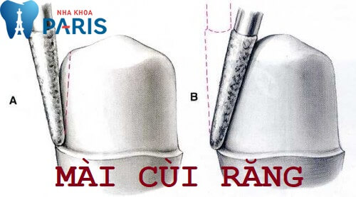 5 nguyên tắc “VÀNG” để mài cùi răng ĐẸP – an toàn – không ê buốt