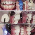 Hé lộ quy trình làm răng sứ 1 Day Tech chỉ trong 1 ngày
