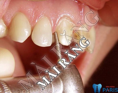 Giải đáp thắc mắc: Mài răng là gì? Mài răng có đau không?