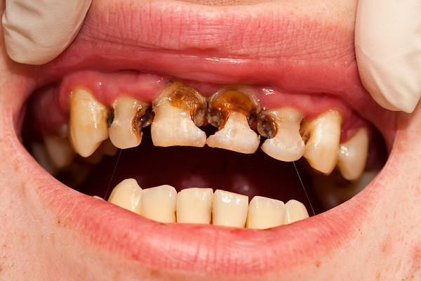 Răng cửa bị sâu cần được điều trị triệt để tránh lan vào trong tủy