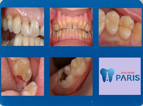 TỔNG HỢP 5 câu hỏi thường gặp nhất về bọc răng hàm