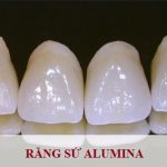 Bọc răng sứ Alumina có CHẤT LƯỢNG không? Nhược điểm là gì?