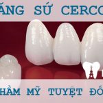 Giải đáp: Chất lượng bọc răng sứ Cercon có tốt không?