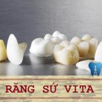 Giải đáp thắc mắc: Bọc răng sứ vita có tốt không?