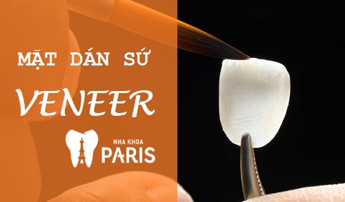 [GIẢI ĐÁP] Trường hợp nào nên làm mặt dán sứ Veneer?