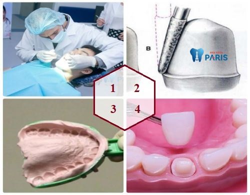 Giả đáp: ” Có Nên hay Không nên làm chụp răng sứ cho răng thưa?”