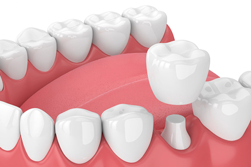 Bọc răng sứ 1 chiếc được không? Giá bao nhiêu tiền?