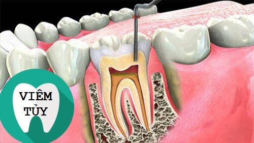 3 Biến chứng sau khi bọc răng sứ bạn cần ĐẶC BIỆT CẢNH GIÁC 3