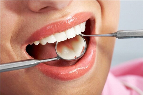 Mặt dán sứ siêu mỏng không cần mài răng nhiều có tốt không? 2