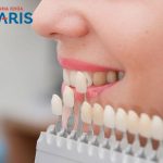 3 yếu tố quyết định đến việc bọc răng sứ màu nào đẹp?