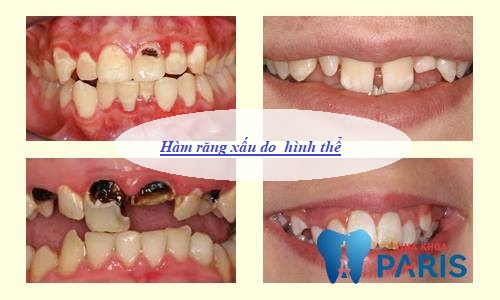 3 Kiểu hàm răng xấu Thường Gặp và cách khắc phục Hiệu Quả Nhất 3
