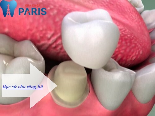 TOP 4 cách làm răng hết hô Nhanh và phổ biến nhất hiện nay