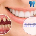 Bọc răng sứ giá bao nhiêu Chuẩn Nhất! Bảng giá ƯU ĐÃI TỚI 40%
