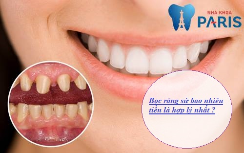Bọc răng sứ giá bao nhiêu Chuẩn Nhất! Bảng giá ƯU ĐÃI TỚI 40%
