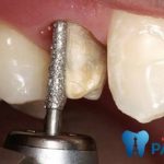 Mài răng nhọn là gì? Thực hiện như thế nào và cần lưu ý những gì?