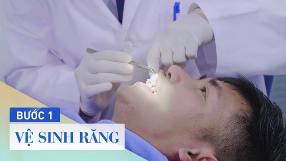 Quy trình bọc răng sứ Nano Shining 5S