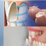 Dán răng sứ Veneer: Giải pháp thẩm mỹ răng – Bảo vệ răng thật tối đa