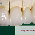 Răng sứ Ceramill có tốt không? Đâu là dòng sứ TỐT NHẤT hiện nay?