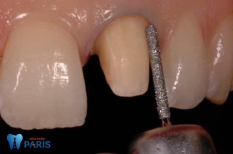 Răng sứ Ceramill mài cùi răng thật nhiều hơn một số loại răng toàn sứ khác