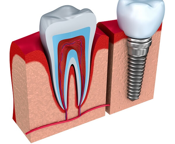 răng implant tồn tại bao lâu
