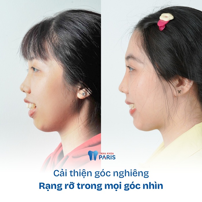 Cải thiện rõ rệt khuôn miệng sau khi niềng răng tại Paris